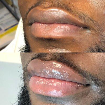 Lip injections with Juvederm