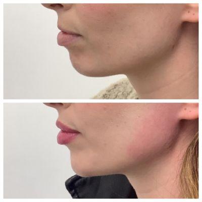 Lip Filler & Chin Filler