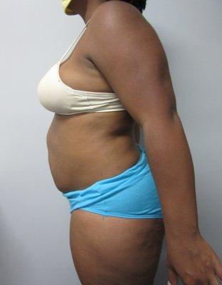 Tummy Tuck Surgery - Before