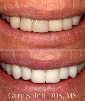 This patient had upper crowns done from another prosthodontist and was very unhappy with unnatural look. Dr. Solnit recreated her smile.