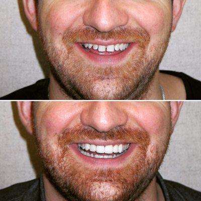 Just a simple smile makeover can change your entire appearance!