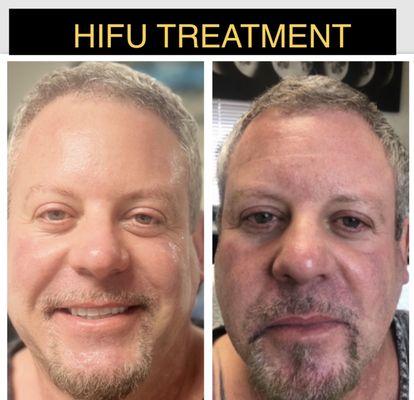 HIFU Facial Treatment