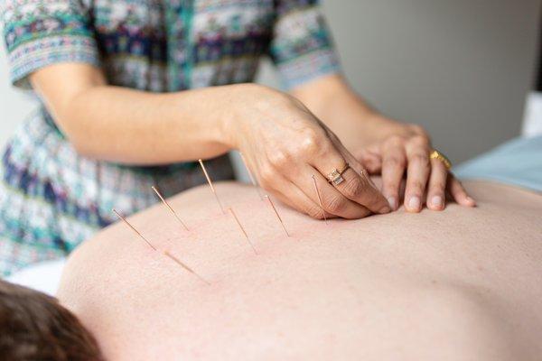 Acupuncture treatment on the back for pain relief.