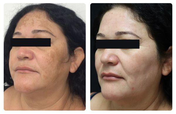 Melasma before & after