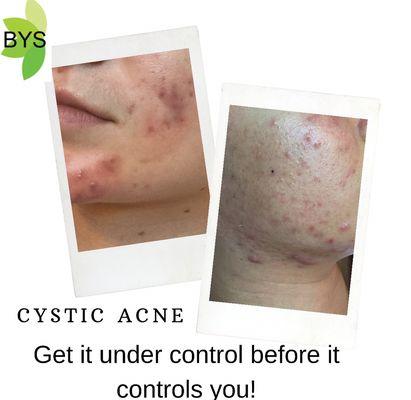 Cystic Acne can be controlled and we can help.