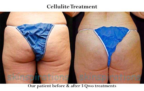 Our patient before & after 3 injectable cellulite treatments