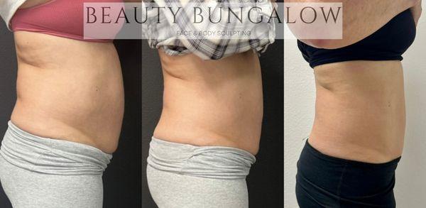 Beauty Bungalow Face and Body Sculpting