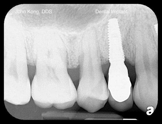 Dental Implant to replace a missing tooth