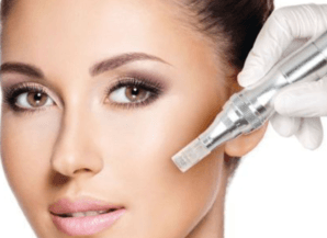 Microneedling Treatment