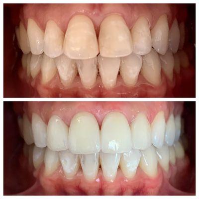 4 veneers and whitening makes a huge difference!