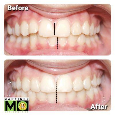 Dental midlines correction with braces