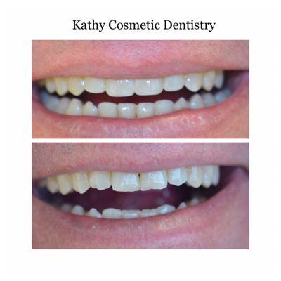 Uneven smile was restored with bonding (minimal Invasive dentistry)