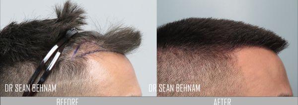 FUE hair transplant:  hairline hair transplant. Notice the naturalness and density. Work performed by Dr Sean Behnam.