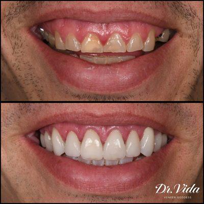 Smile Makeover with crown lengthening and osseous removal prior to veneers and bridge from travedling patient. done by Dr. Vida