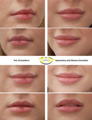 Lip fillers