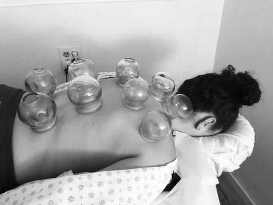 Fire cupping.