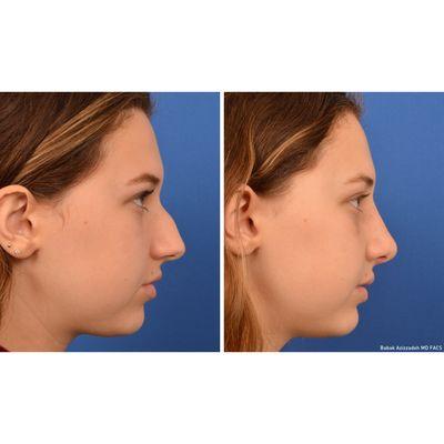 Teenage rhinoplasty