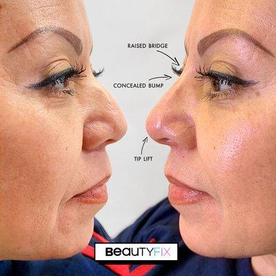 NoseFix gave our client an instant lift!