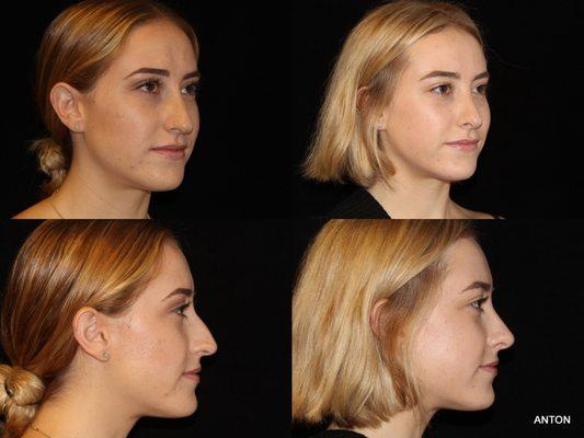 28 year old woman, 5'2″, 120 lbs., rhinoplasty before and after photos, Newport Beach, CA