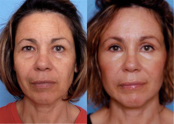 Facelift, neck lift, brow lift, blepharoplasty, CO2 laser