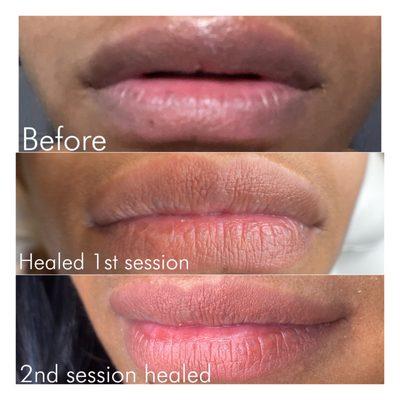 Lip neutralization healed