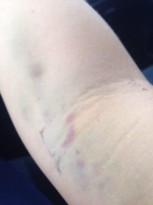 Purple bruising at 3 days after blood test. I am not on any medication & I never bruise after blood draws.