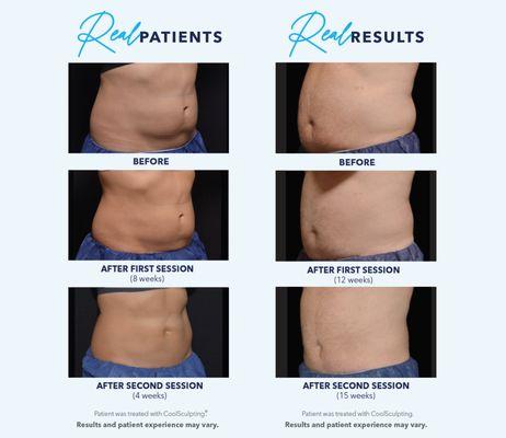 CoolSculpting Real Results - Our Real Results Promise