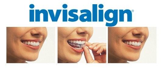 We offer Invisalign - a great cosmetic way of straightening your teeth