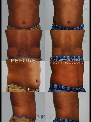 CoolSculpting Before and After in Abdomen