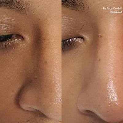 Facials 
Before and after Results