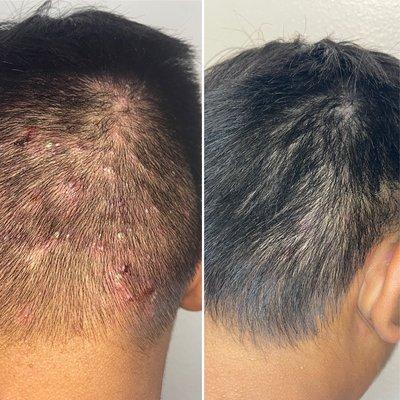 Before /After  21 days progress on a teen with severe acne breakouts all over his scalp.