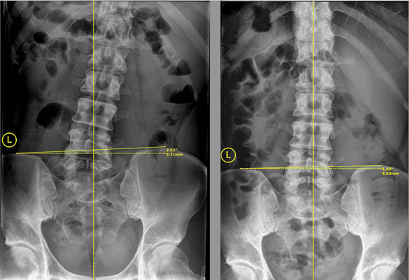 6 week corrective care plan progress!