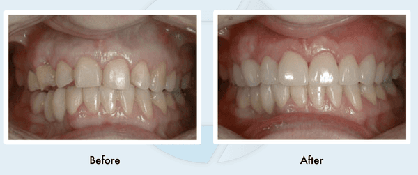 Before and after, at Oral Construx!