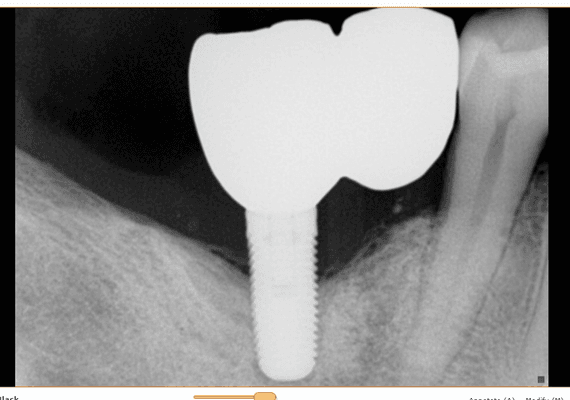 No bone grafting in place to support the implant