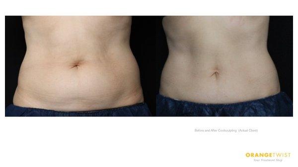 Coolsculpting Before and After! #coolsculpting #beforeandafter #orangetwist