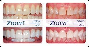 Want brighter teeth? We offer the latest in Teeth Whitening Technology with Zoom!