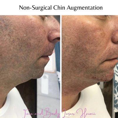 1 syringe of Juvederm Voluma in the chin