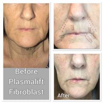 Fibroblast