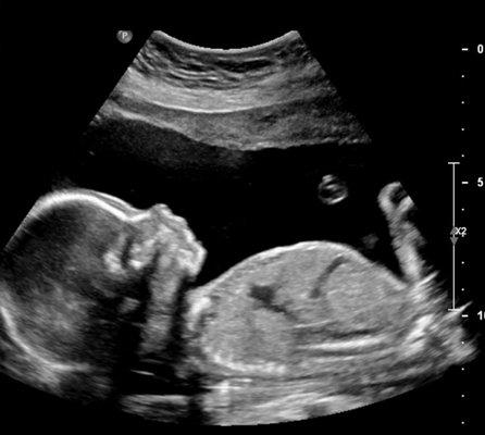 Precious 2D ultrasound