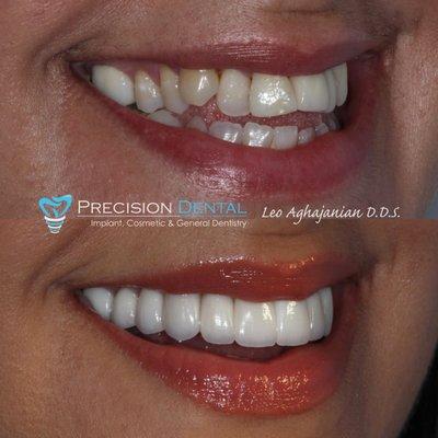 After many years of insecurities about her smile, it was Dr.Leo's pleasure to perform a life altering smile rehabilitation for his patient.