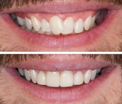 Correction of a gummy smile and crowding by veneers and lip repositioning.