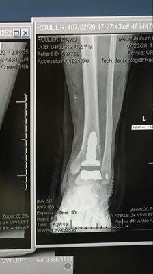 Ankle replacement