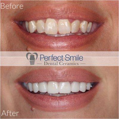 Smile makeover using our Super Translucent solid zirconia