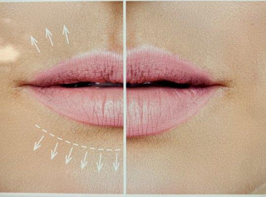 Look what lip filler can do for you!