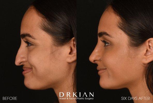 Persian Rhinoplasty Before & After 6 Days, performed by Dr. Kian Karimi.