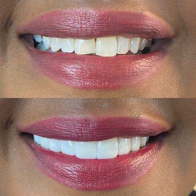 Uneven teeth before/after