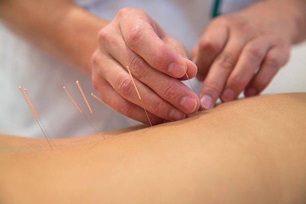 Acupuncture for Lower Back Pain