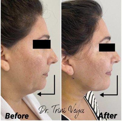 Jaw line liposuction With Renuvion J plasma  Dr Trini Vega