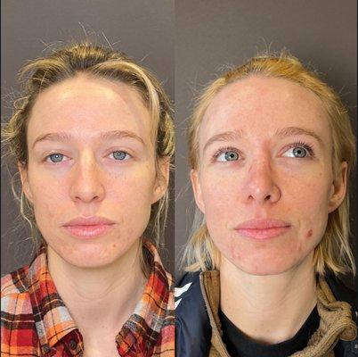 Female 1 Year After Closed Rhinoplasty