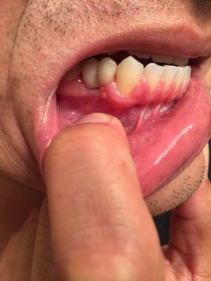 You can see the gap between the implant and the gum, also look at the discoloration.